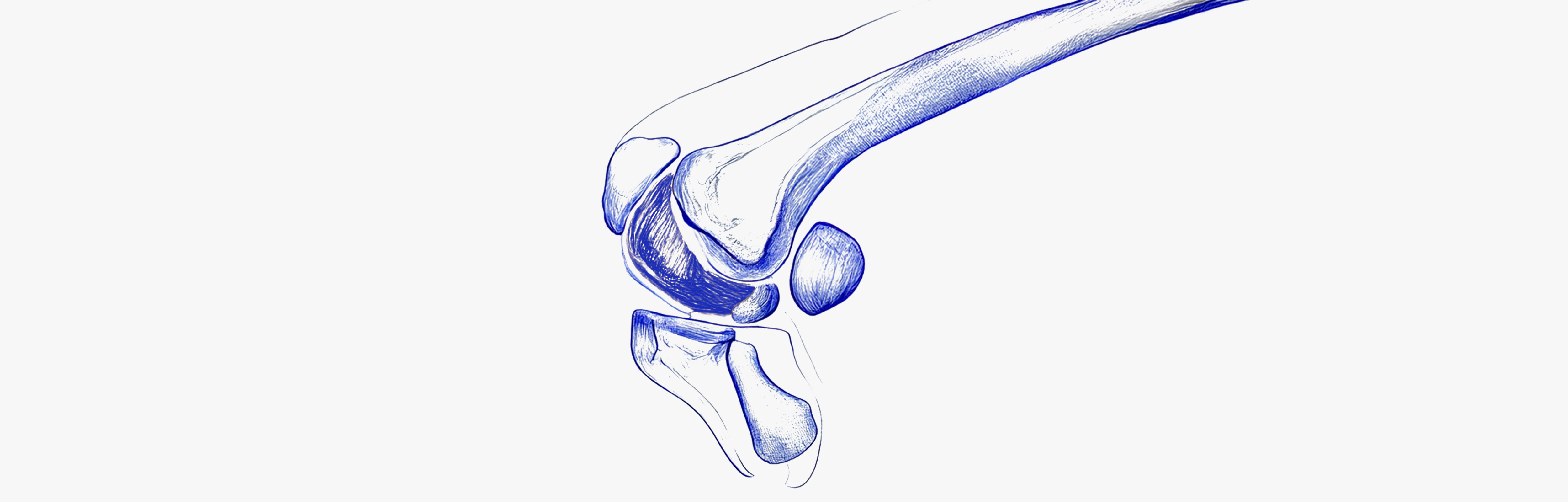 Aliments qui augmentent l'arthrose
