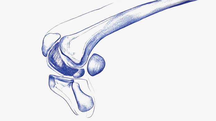 Aliments qui augmentent l'arthrose